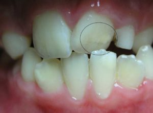 Флюороз - як розпізнати та лікувати флюороз