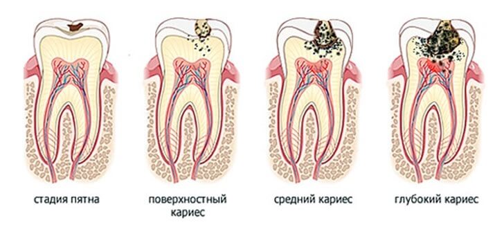 Карієс зубів