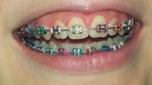 кольорові брекети