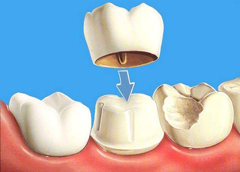 Види зубних протезів