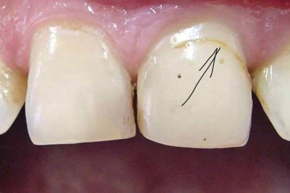 ЧОМУ ЧОРНІЄ ЗУБ ПІД ПЛОМБОЮ