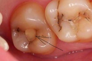 Чи може полікований зуб руйнуватись під пломбою