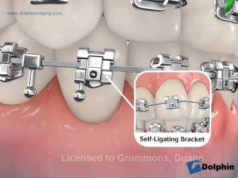 Конструкція брекетів
