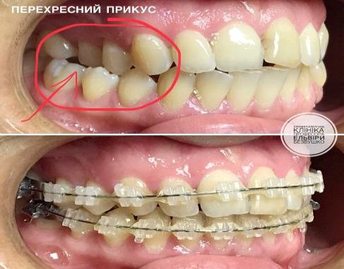 чому болить голова від зуба