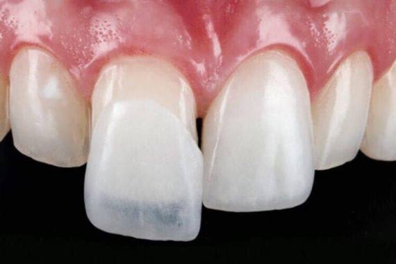 вініри на зуби у Львові