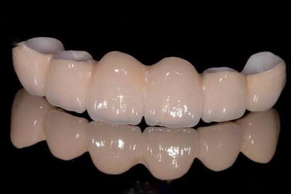 Цирконієва коронка