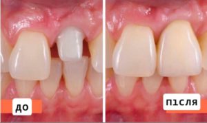 Цирконієва коронка, фото до і після