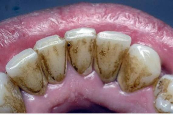 Зубний камінь