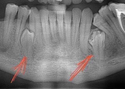 Ретенований зуб