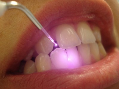 Лазерне лікування зубів