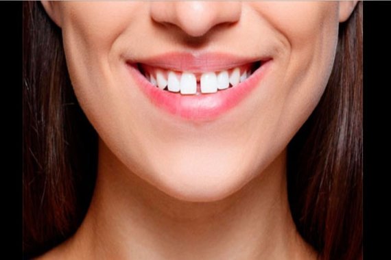 Підрізання вуздечки губи або язика