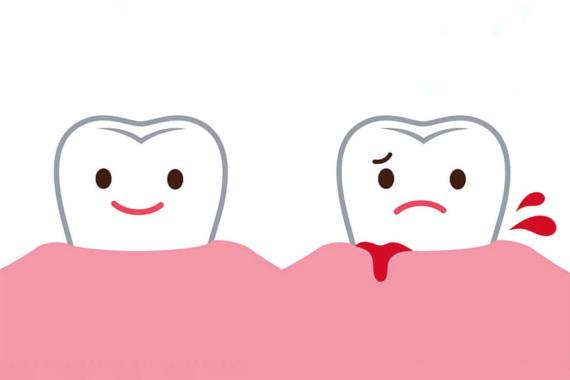 Кровоточивість ясен