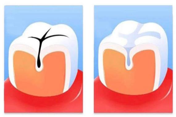 Герметизація фісур