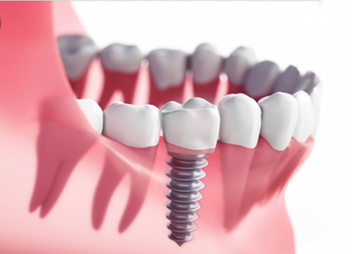 Техніки та види імплантації зубів