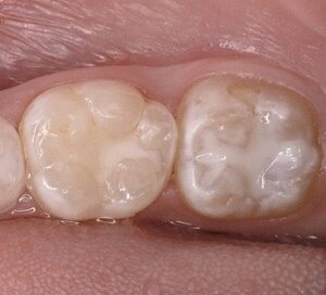 герметизація фісур ціна