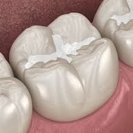 герметизація фісур це фото, ціна, стоматологічні послуги у Львові