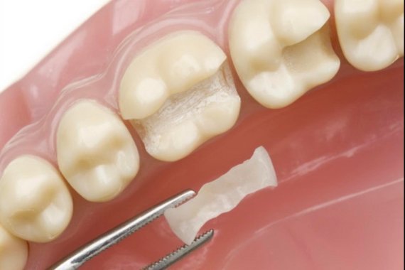 Керамічні вкладки