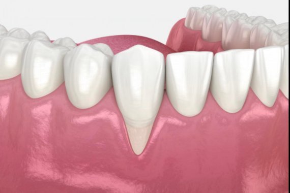 Контурна пластика ясен