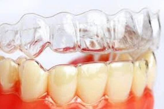 Виправлення прикусу у дорослих без брекетів за допомогою елайнерів