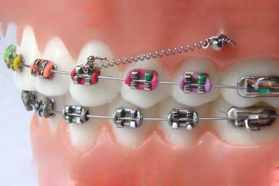 Мікроімпланти в ортодонтії