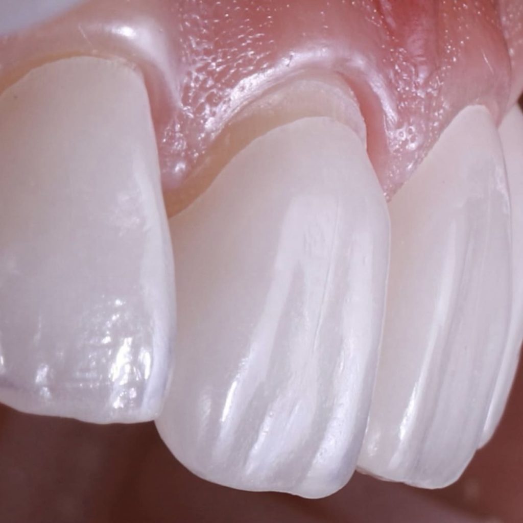 зубні вініри, встановлення у Львові