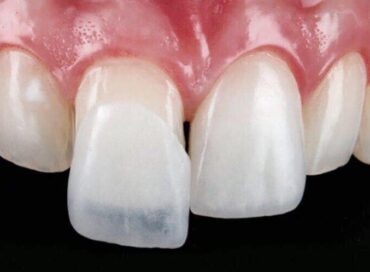 вініри на зуби у Львові