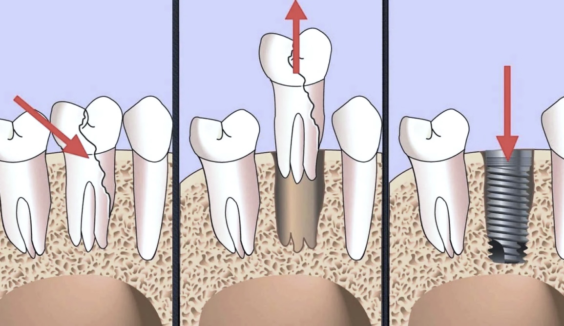 Одномоментна та одноетапна імплантація зубів у Львові