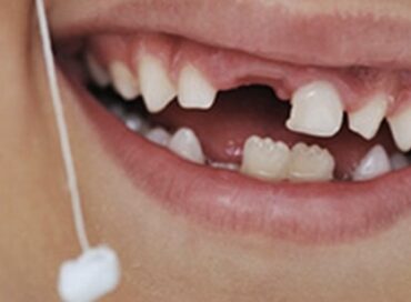 залишився корінь молочного зуба