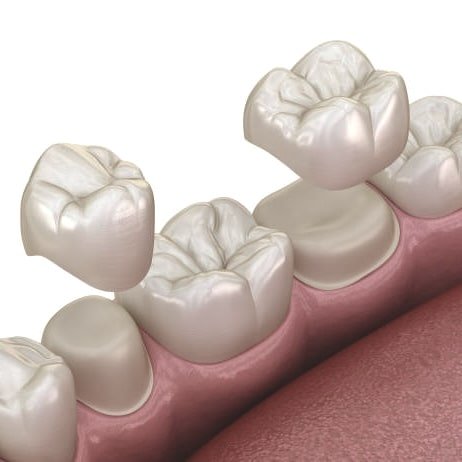 як ставлять коронки на передні зуби та жувальні зуби