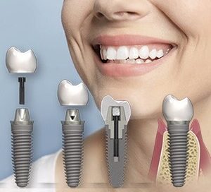 імплант штрауман ціна