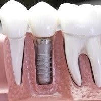 скільки служать імпланти