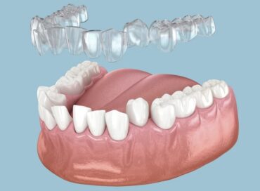 елайнери, як вирівняти зуби без брекетів