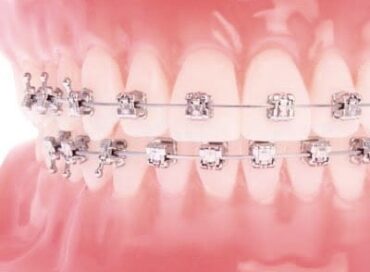 як брекети вирівнюють зуби
