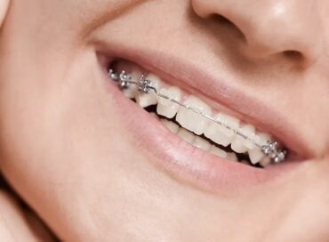 вирівнювання зубів ціни