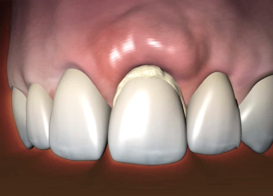 як лікувати флюс, періостит