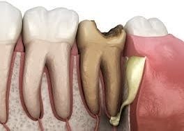лікування періоститу