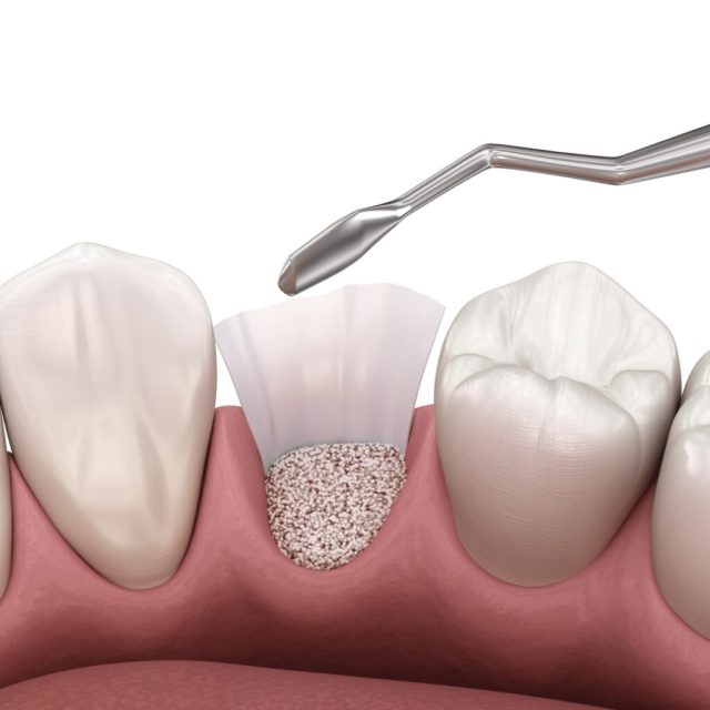 ремоделювання кісткової тканини, нарощування та відновлення зубної кістки