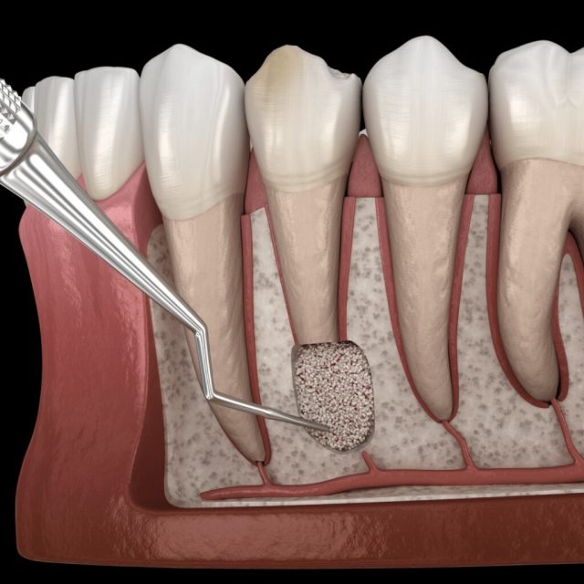 резекція верхівки кореня ціна