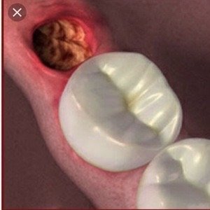 альвеоліт, як лікувати альвеоліт зуба