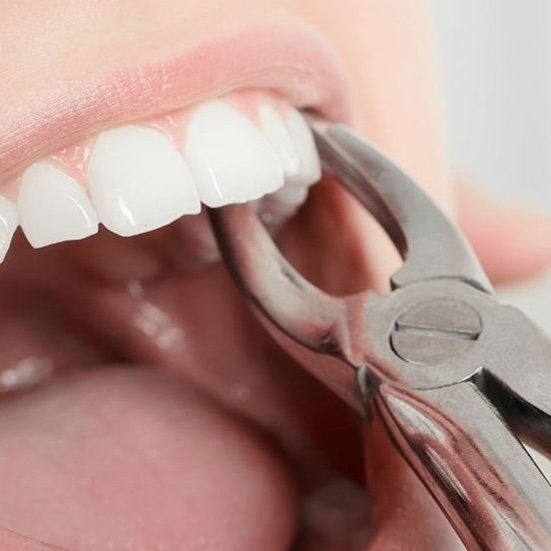 що таке атипове видалення зуба