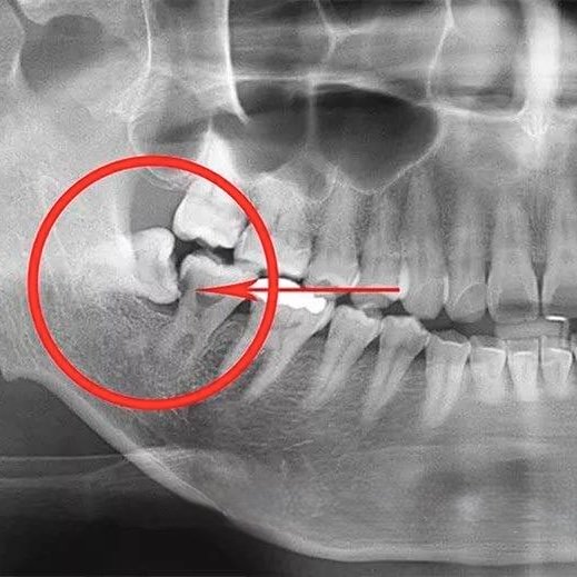 видалення зуба атипове