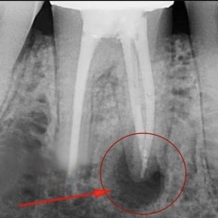 резекція верхівки кореня зуба ціна