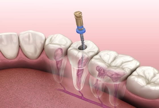 як виглядає нерв зуба
