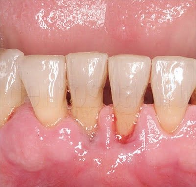 пародонтит фото