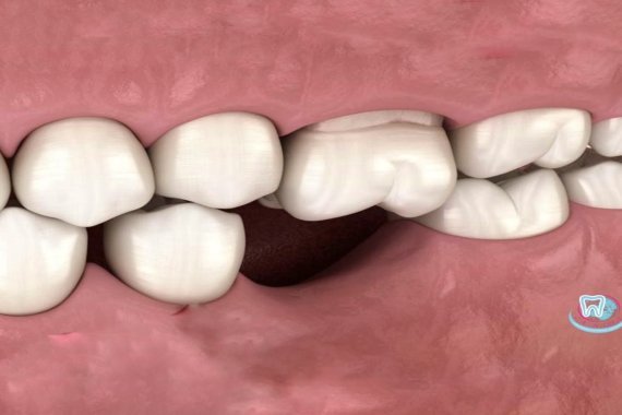 відсутність зубів, адентія