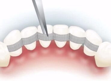 шинування щелепи та зубів