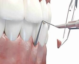 пародонтолог у Львові, пародонтологія