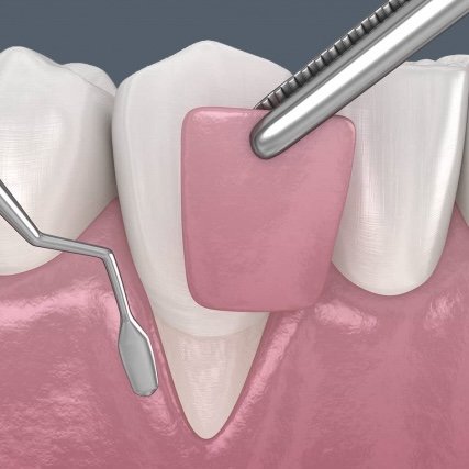 рецесія ясен, ліікування та профілактика