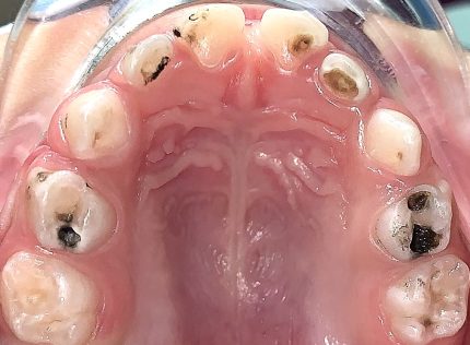 карієс молочних зубів у дітей фото