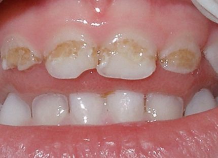 карієс молочних зубів фото